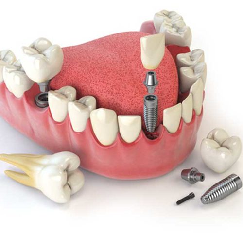 بررسی اجزای مختلف ایمپلنت دندان و کاربرد آن ها | شرکت نخ دندان مینا