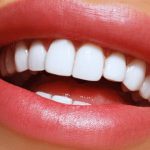 لمینت یا کامپوزیت دندان؛ کدام بهتر است؟