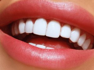 لمینت یا کامپوزیت دندان | شرکت نخ دندان مینا