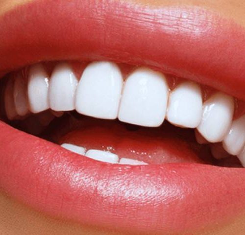 لمینت یا کامپوزیت دندان | شرکت نخ دندان مینا