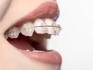شناخت کامل انواع سیم ارتودنسی در براکت | شرکت نخ دندان مینا