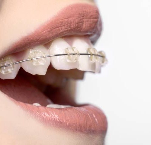 شناخت کامل انواع سیم ارتودنسی در براکت | شرکت نخ دندان مینا