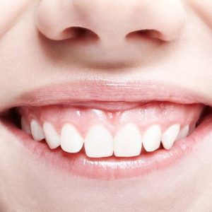 لبخند لثه ای یا gummy smile چیست؟ | شرکت نخ دندان مینا