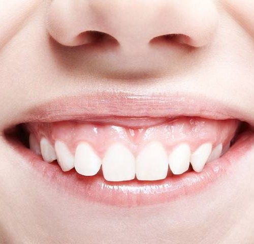 لبخند لثه ای یا gummy smile چیست؟ | شرکت نخ دندان مینا
