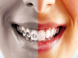 10 عارضه درمان ارتودنسی | شرکت نخ دندان مینا