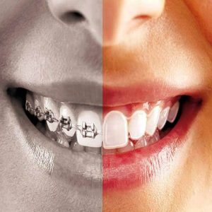 10 عارضه درمان ارتودنسی | شرکت نخ دندان مینا