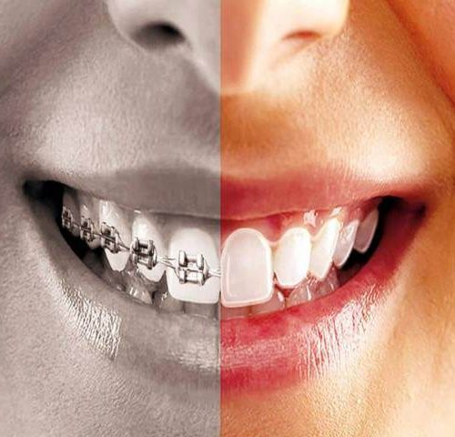 10 عارضه درمان ارتودنسی | شرکت نخ دندان مینا