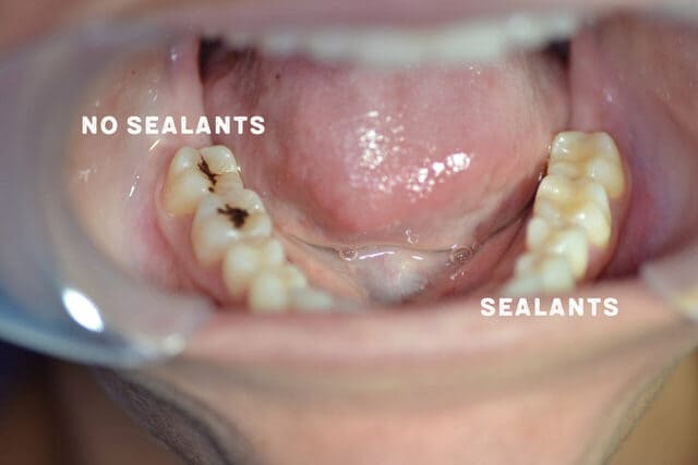 فیشور سیلانت دندان | شرکت نخ دندان مینا