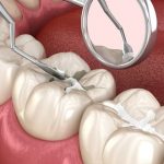 سیلانت دندان چیست و مناسب چه افرادی است؟