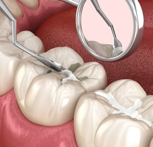 سیلانت دندان چیست | شرکت نخ دندان مینا