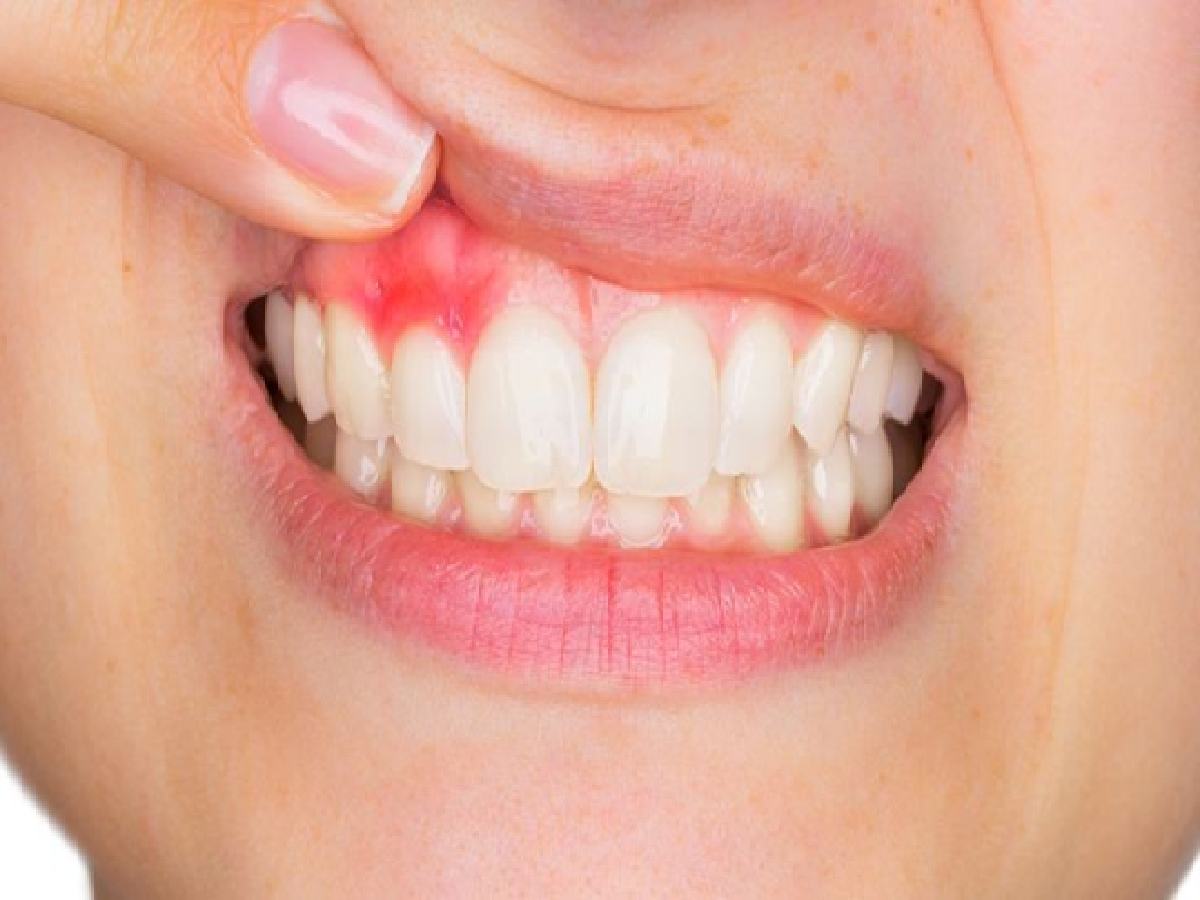 آسیب به بافت های اطراف دندان از دلایل درد دندان بعد از عصب کشی