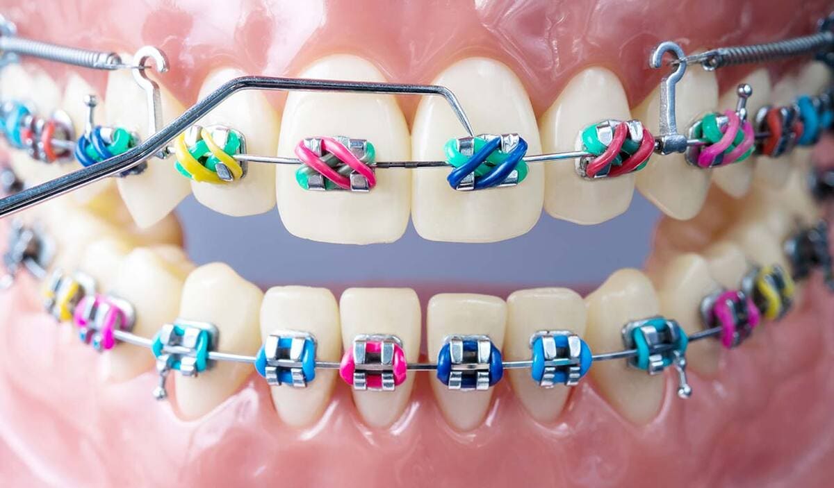 ارتودنسی | نخ دندان مینا