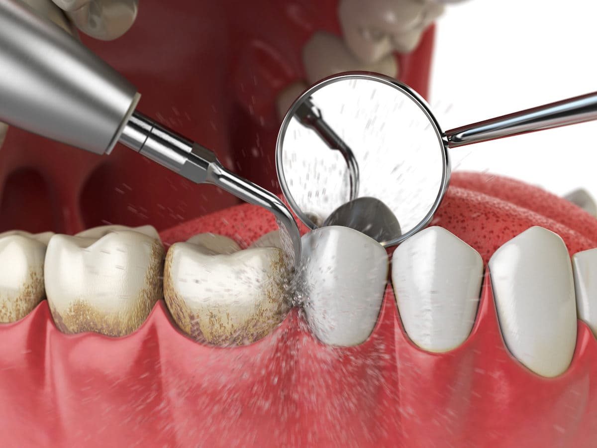 جرم دندان | نخ دندان مینا