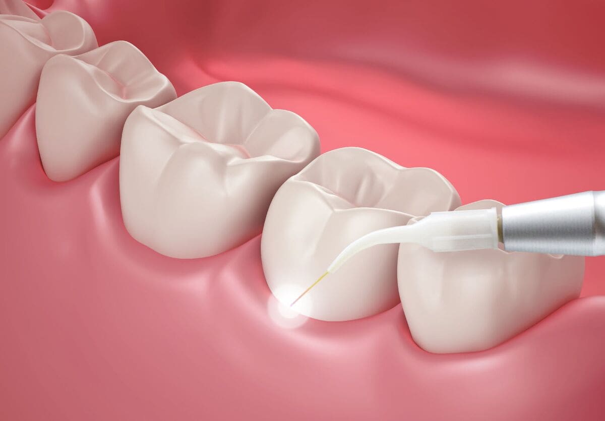 درمان کیست دندان | نخ دندان مینا