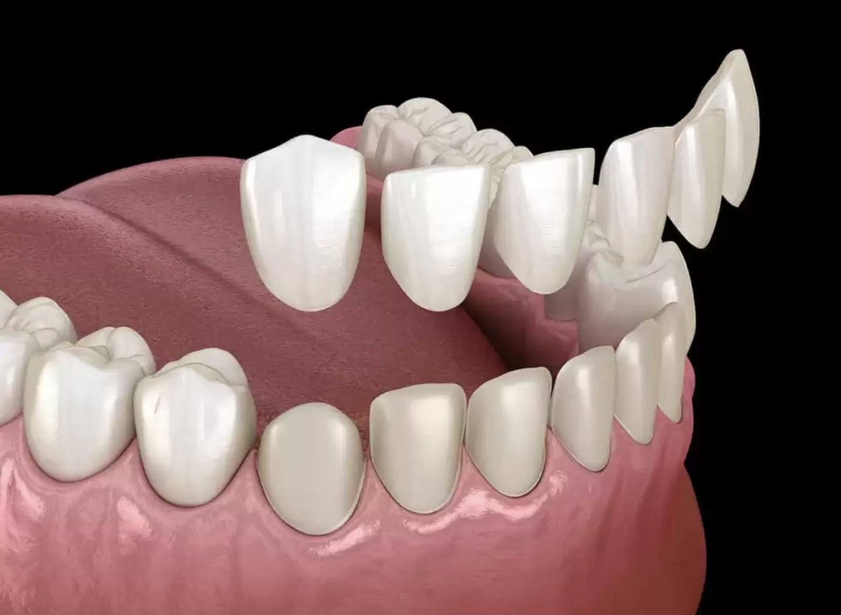 مراحل اجرای لمینت سرامیکی | نخ دندان مینا