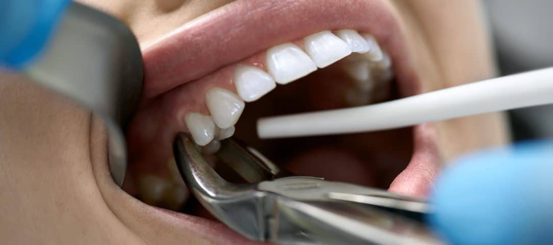 کشیدن دندان در دوران بارداری | نخ دندان مینا