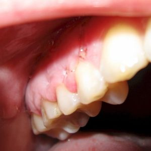 کیست دندان چیست | نخ دندان مینا