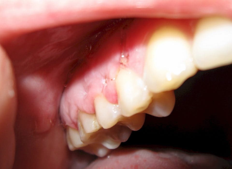 کیست دندان چیست | نخ دندان مینا
