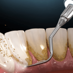 بررسی عوارض جرم گیری دندان