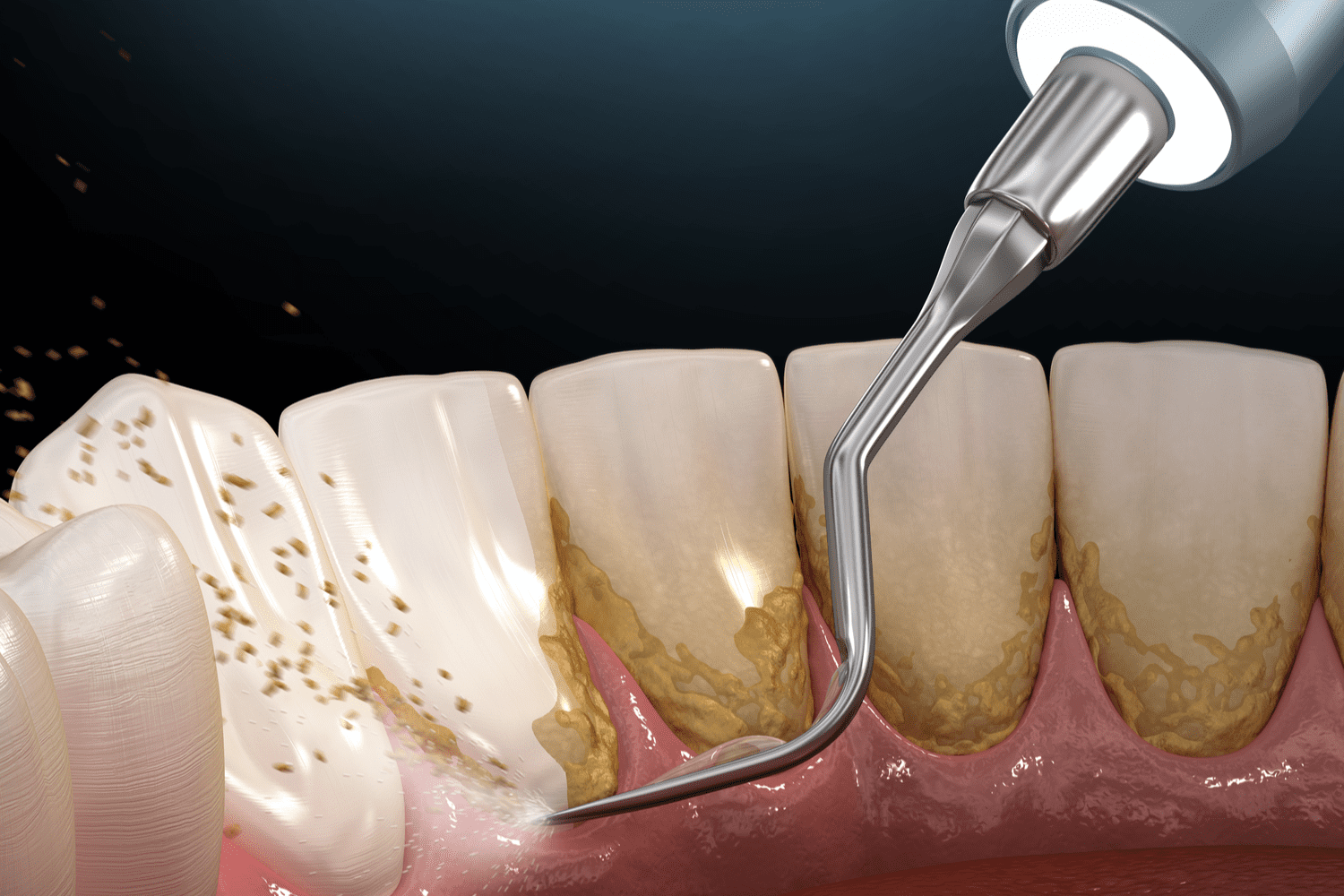 عوارض جرم گیری دندان | نخ دندان مینا