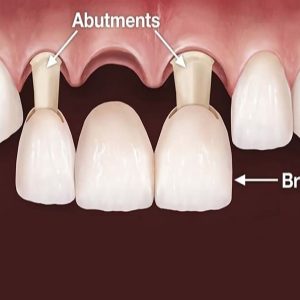 بریج دندان جلو | نخ دندان مینا
