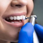 فرق جرم گیری لثه با جرم گیری دندان چیست؟