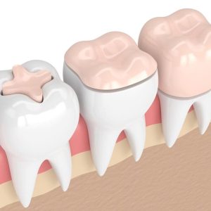 اینله و آنله چیست | نخ دندان مینا