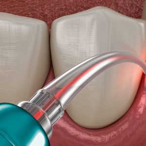 جراحی لثه با لیزر | نخ دندان مینا