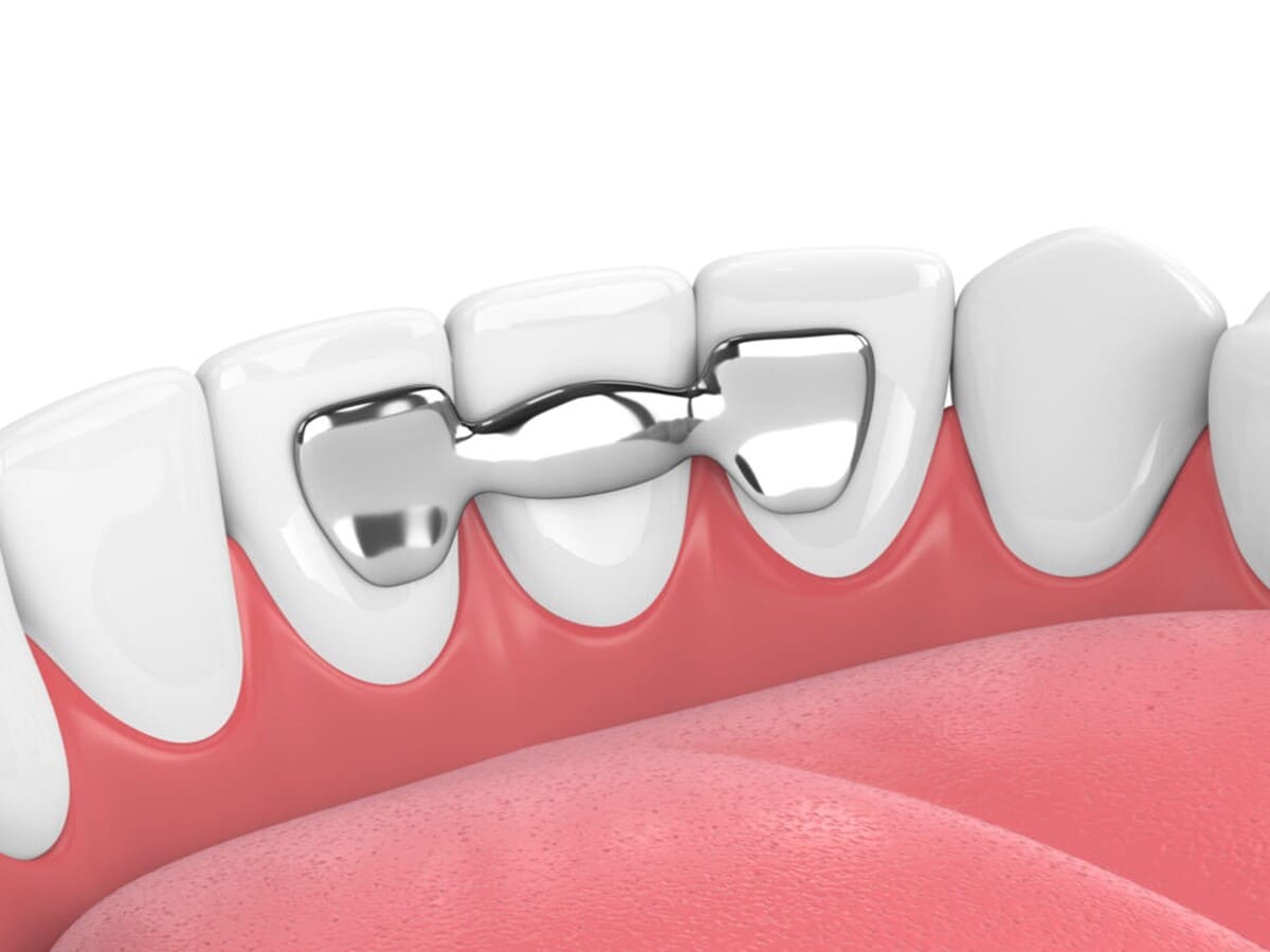 بریج دندان چیست | نخ دندان مینا