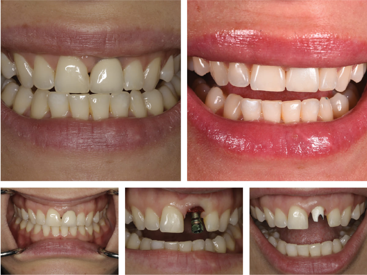 مراحل ایمپلنت دندان جلو | نخ دندان مینا