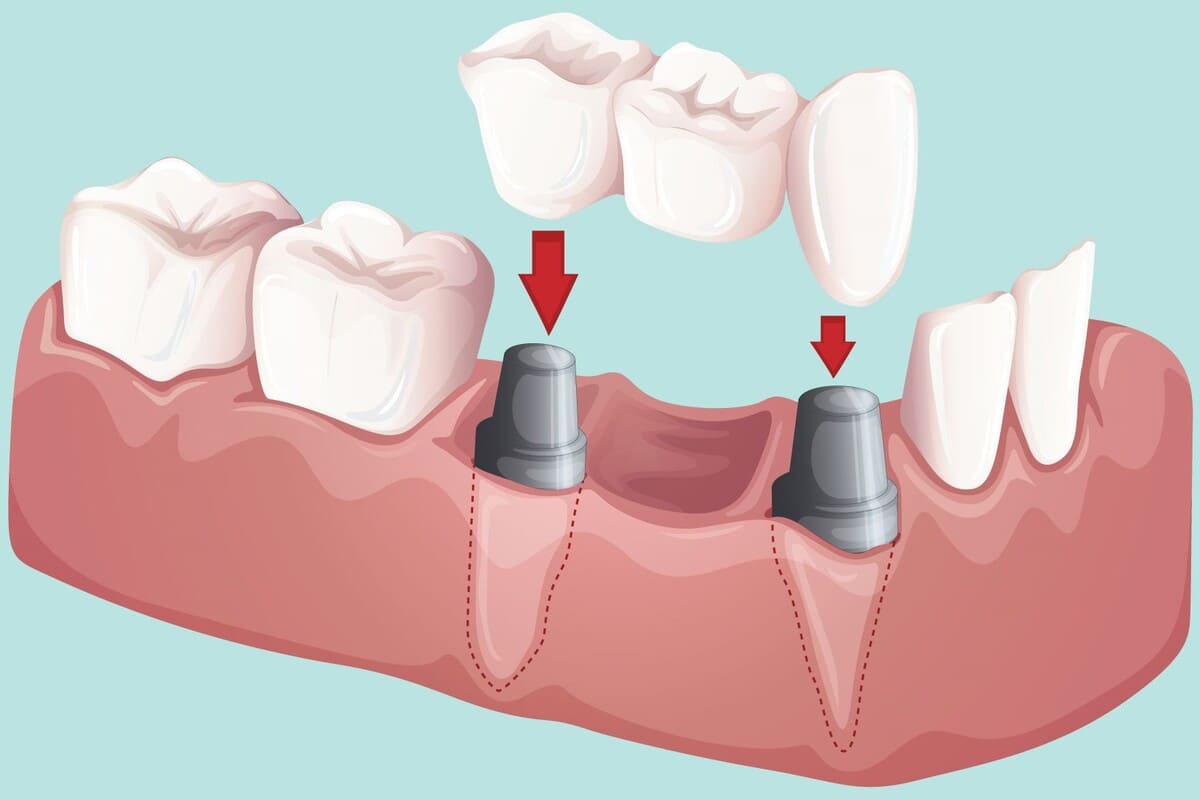 عوارض بریج دندان جلو | نخ دندان مینا
