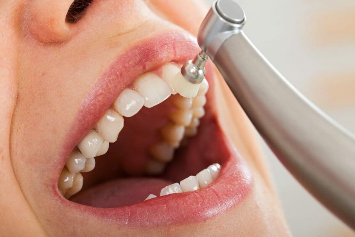 جرم گیری دندان چیست | نخ دندان مینا