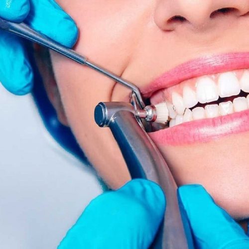 جرم گیری دندان چیست | نخ دندان مینا