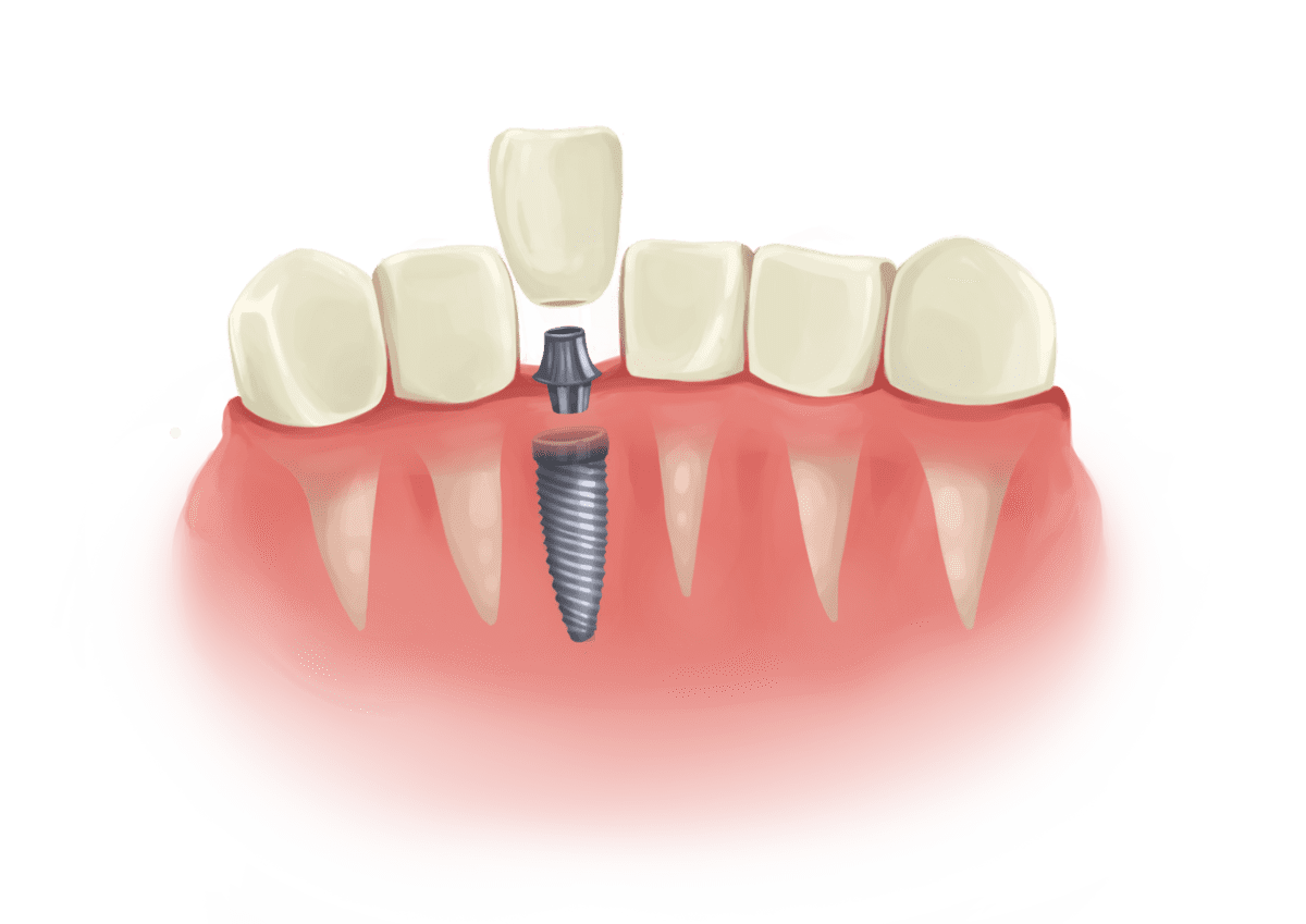 عوارض ایمپلنت نکردن دندان | نخ دندان مینا