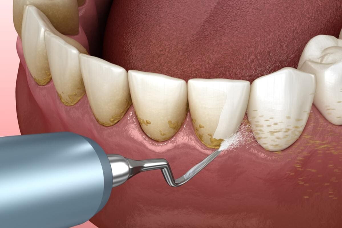 جرم گیری لثه چیست | نخ دندان مینا