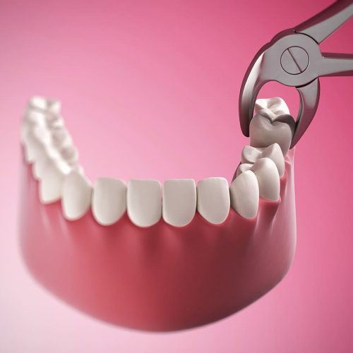 جراحی دندان عقل | نخ دندان مینا