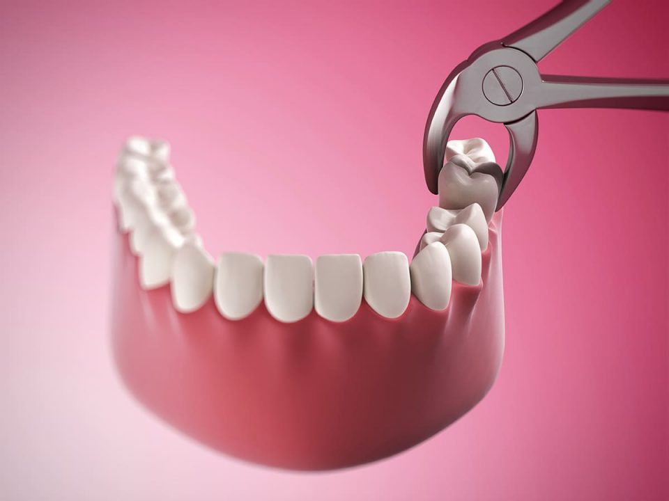 جراحی دندان عقل | نخ دندان مینا