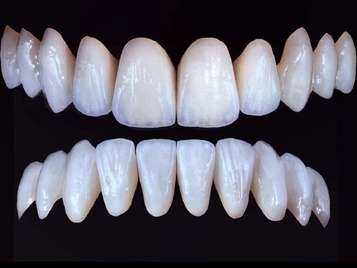 کامپوزیت دندان جلو | نخ دندان مینا