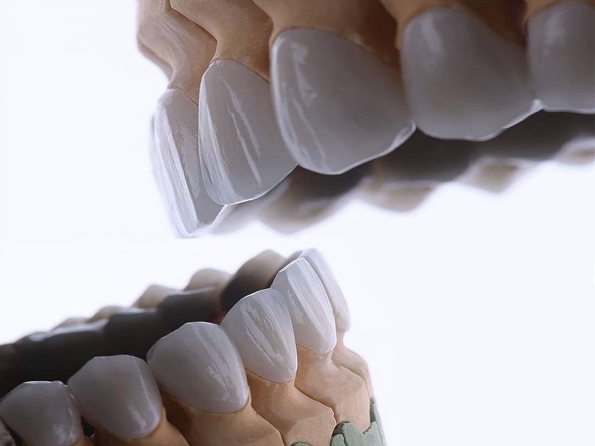 مزایای کامپوزیت دندان | نخ دندان مینا