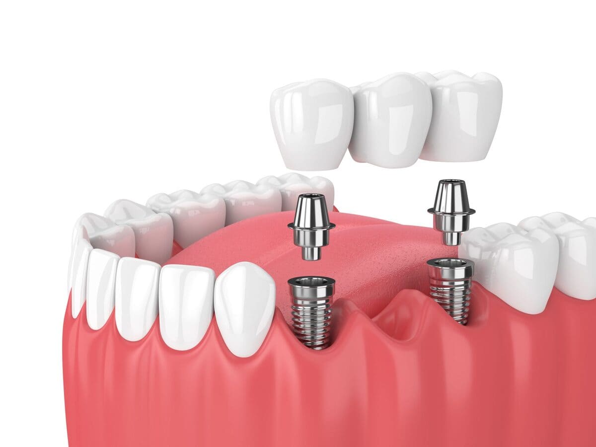 ایمپلنت دندان در بیماران دیابتی | نخ دندان مینا