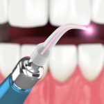 جرمگیری دندان با لیزر چه مزایایی دارد؟