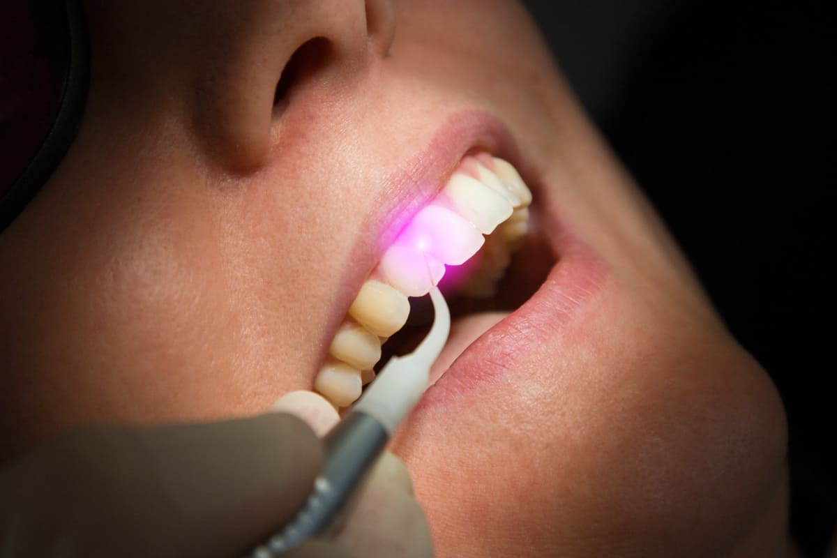جرمگیری دندان چیست | نخ دندان مینا