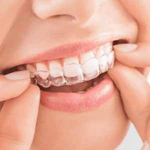 اینویزیلاین چیست | نخ دندان مینا