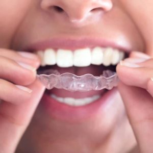 بریس یا اینویزیلاین؟ | نخ دندان مینا