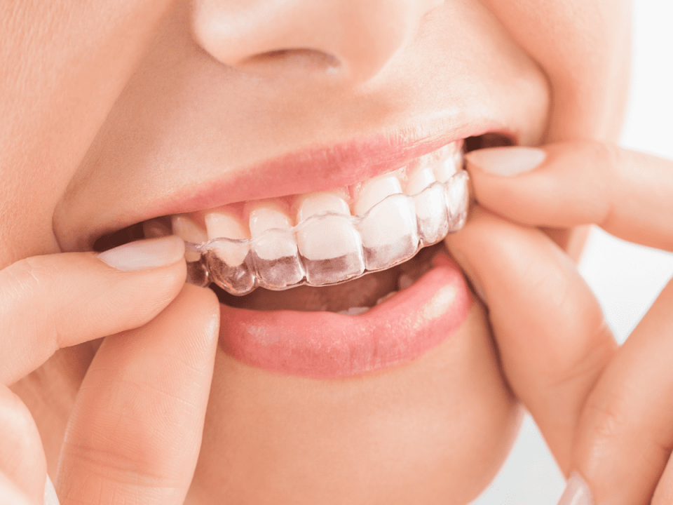 اینویزیلاین چیست | نخ دندان مینا