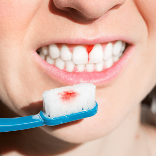 علت خونریزی لثه هنگام مسواک زدن | نخ دندان مینا