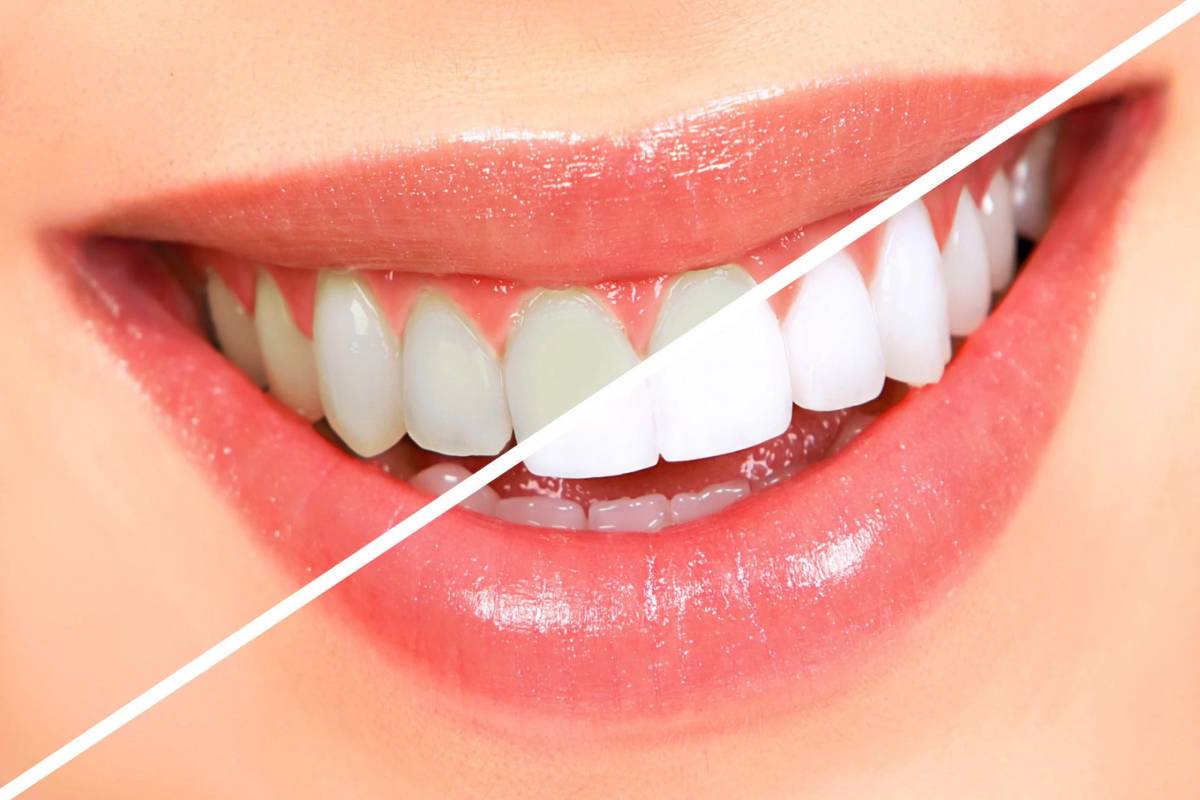 ویژگی استفاده از ایرفلو | شرکت نخ دندان مینا