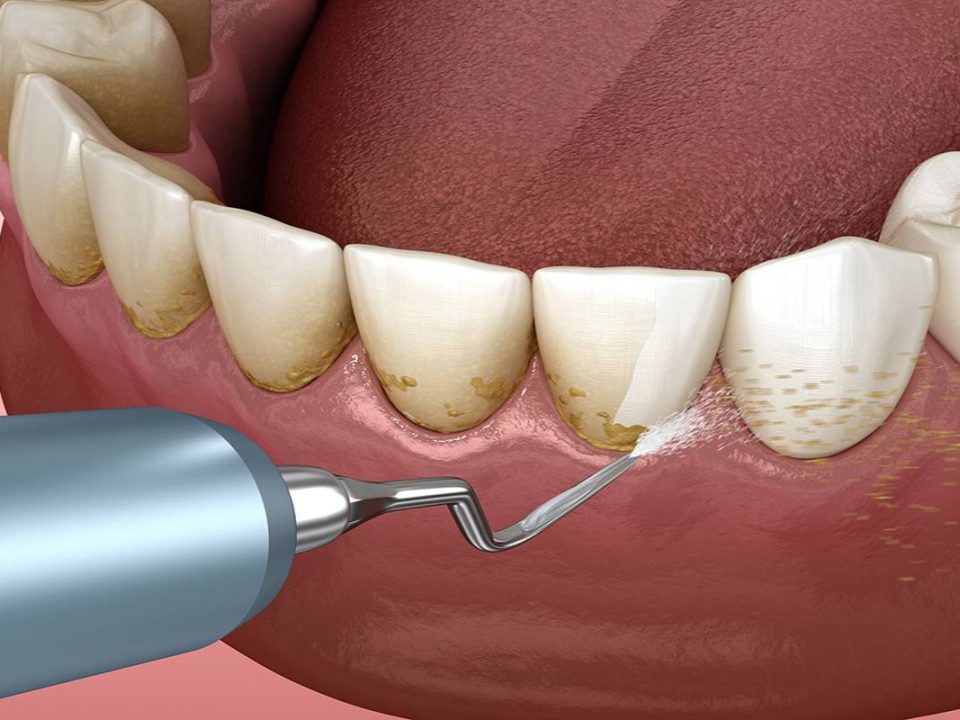 ایرفلو چیست و چه ویژگی‌هایی دارد؟ | شرکت نخ دندان مینا