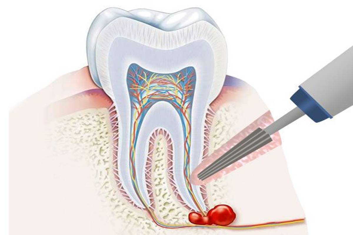 دلایل اهمیت داشتن درمان ریشه | شرکت نخ دندان