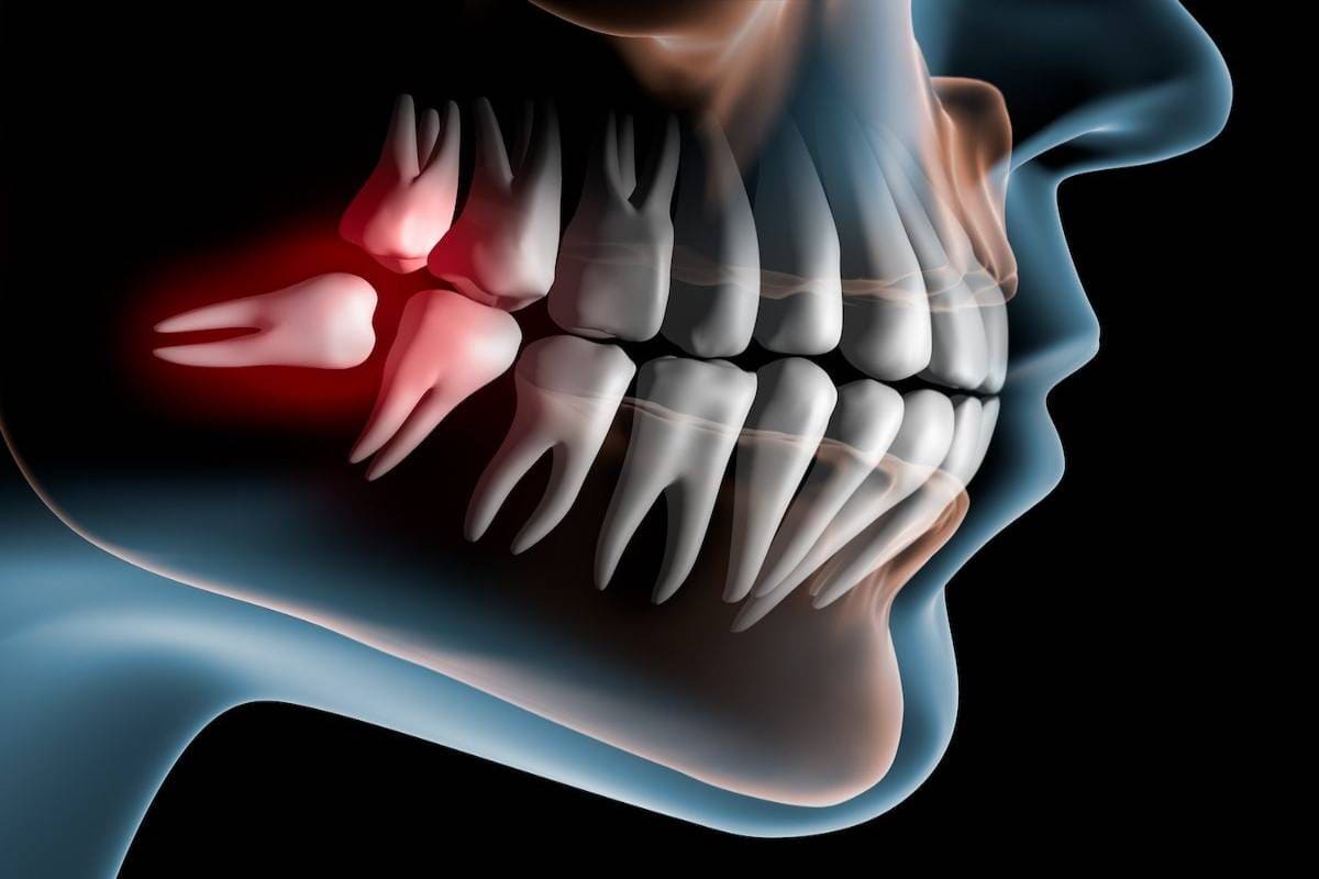 دلیل عفونت دندان عقل چیست؟ | شرکت نخ دندان مینا